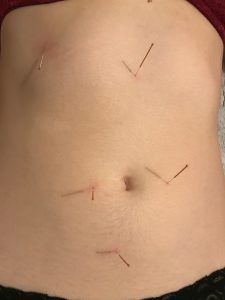 Acupuncture dans l'abdomen et le torse